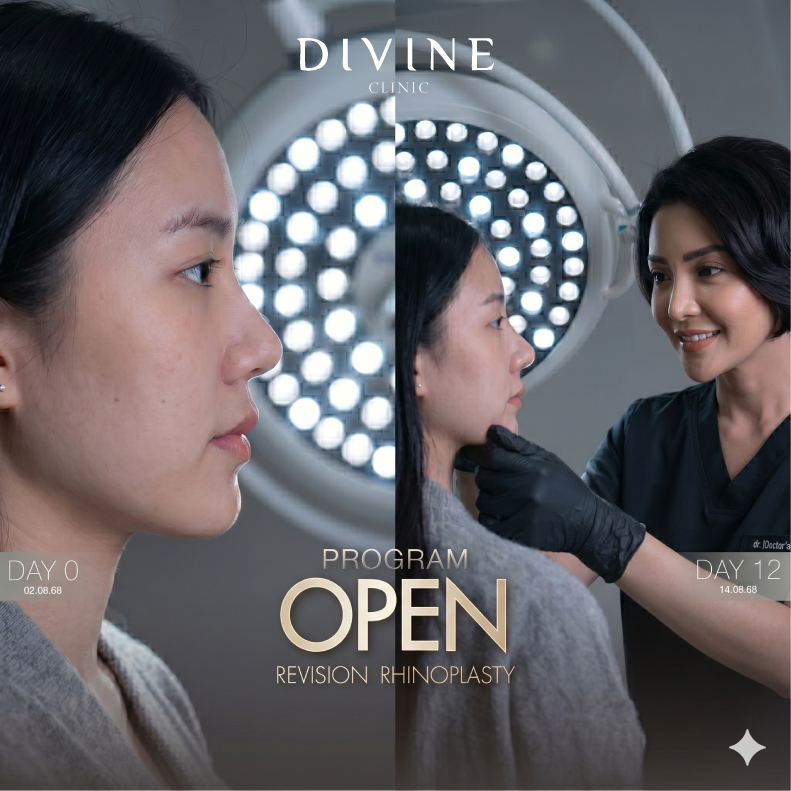 Revision Rhinoplasty Program – Before & After