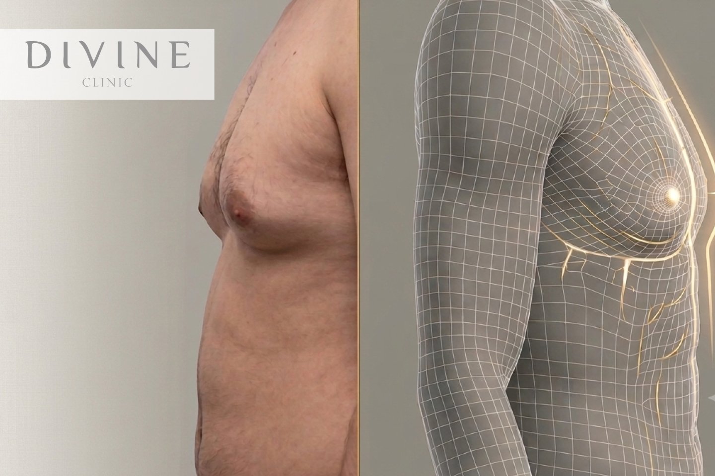 Breast Reduction